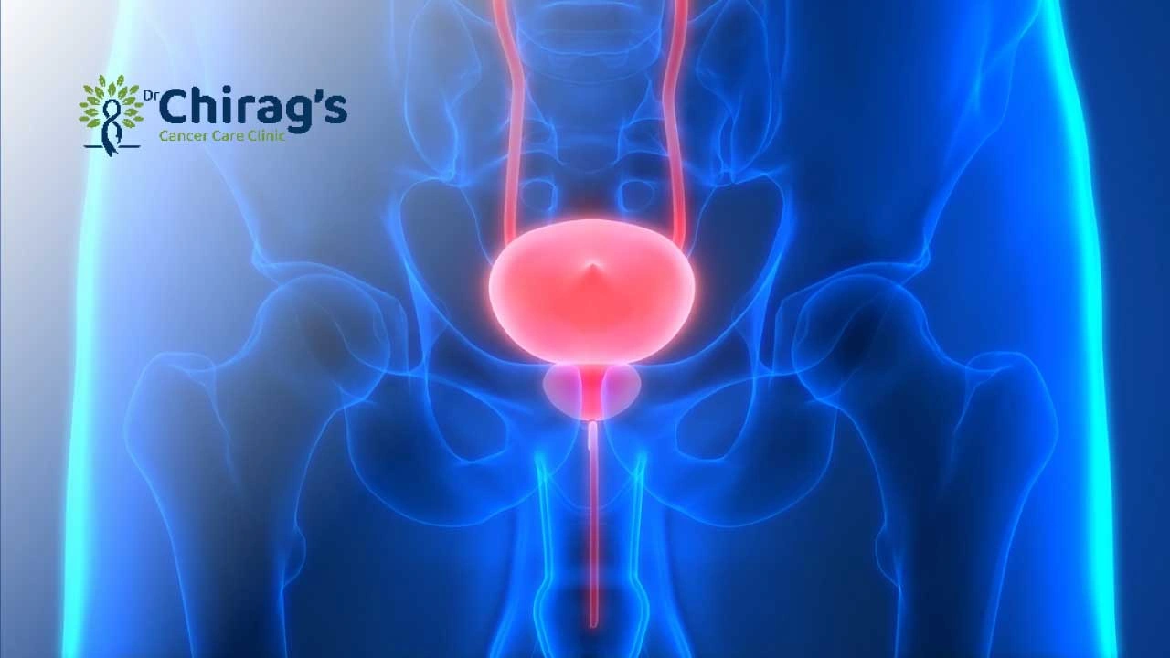how-i-knew-i-had-bladder-cancer
