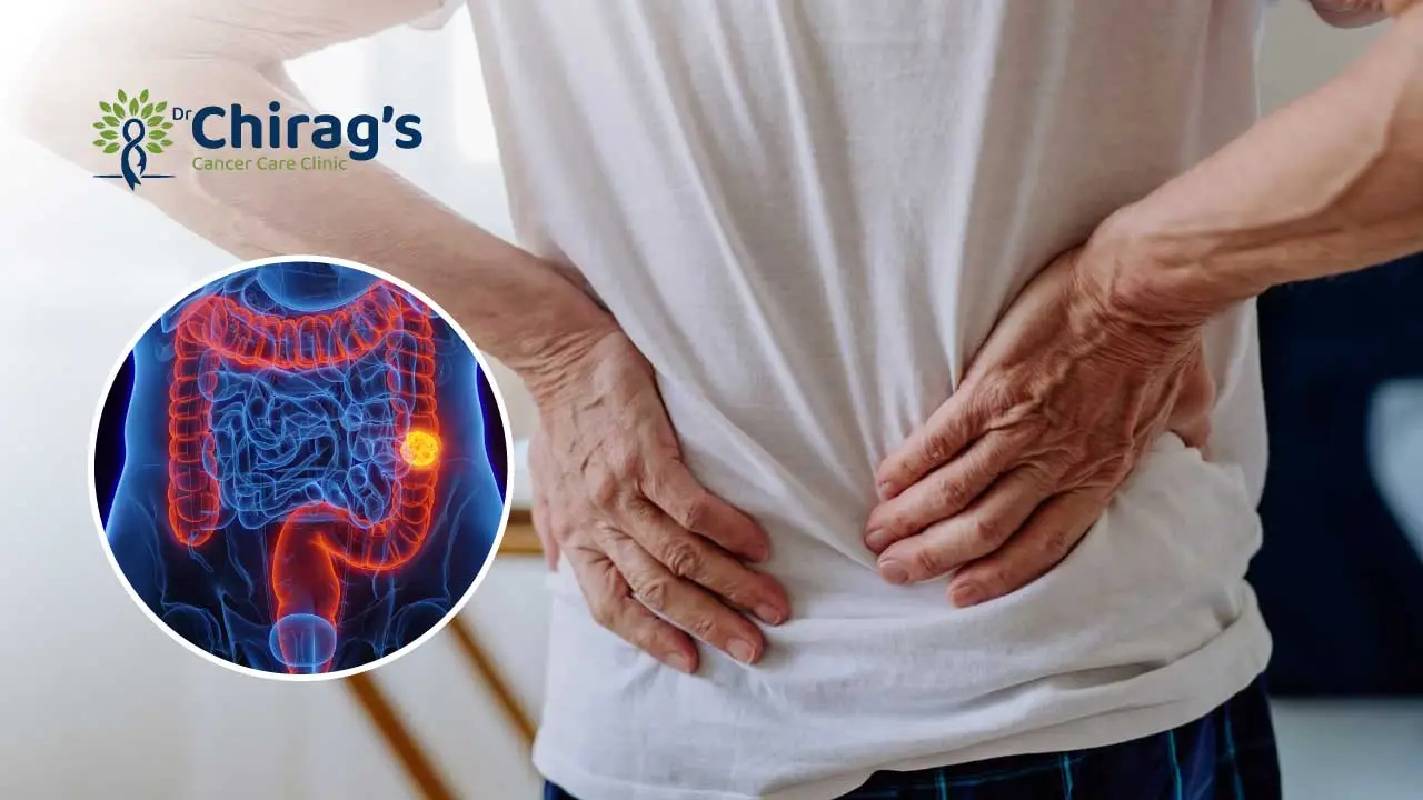Can-colon-cancer-cause-back-pain Can colon cancer cause back pain