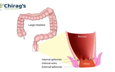 Sphincter-preserving surgeries for rectal cancer