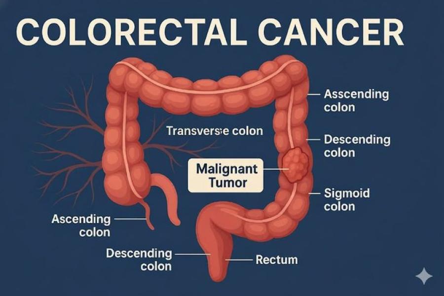 Colon cancer treatment in Pune by Dr. Chirag Bhirud using advanced robotic colorectal surgery
